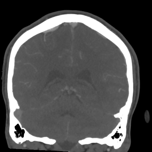 Cerebral arteriovenous malformation (Spetzler-Martin grade 2) (Radiopaedia 41262-44076 F 44).png