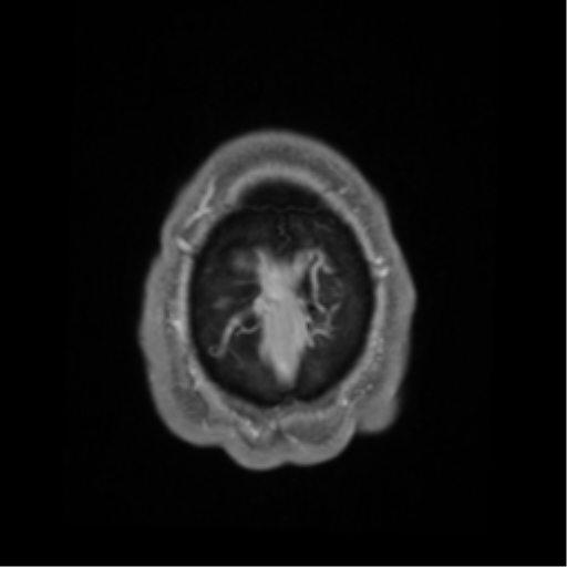 Cerebral arteriovenous malformation - huge (Radiopaedia 35734-37272 Axial T1 C+ 72).png