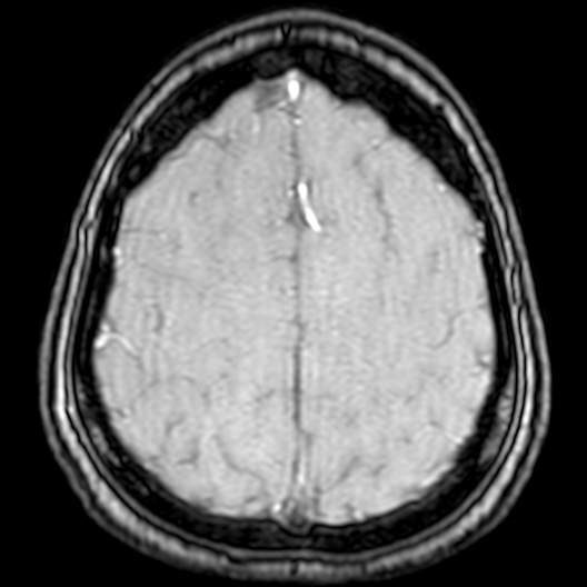 Cerebral arteriovenous malformation at posterior body of corpus callosum (Radiopaedia 74111-84925 Axial MRA 184).jpg