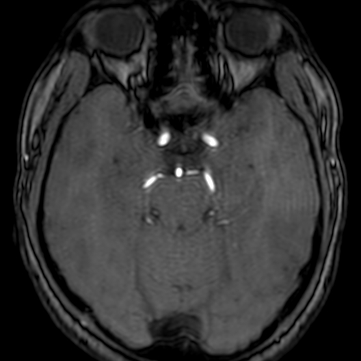 Cerebral arteriovenous malformation at posterior body of corpus callosum (Radiopaedia 74111-84925 Axial MRA 72).jpg