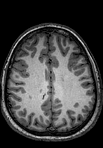 Cerebral arteriovenous malformation at posterior body of corpus callosum (Radiopaedia 74111-84925 Axial T1 87).jpg