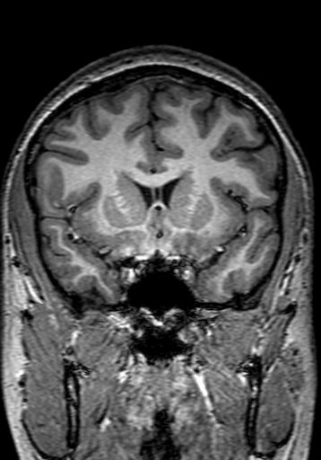 File:Cerebral arteriovenous malformation at posterior body of corpus callosum (Radiopaedia 74111-84925 Coronal T1 111).jpg