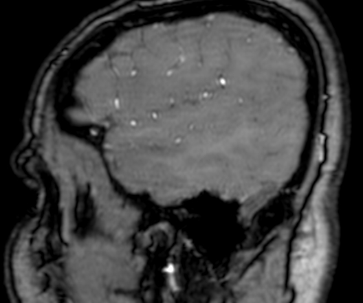 Cerebral arteriovenous malformation at posterior body of corpus callosum (Radiopaedia 74111-84925 J 35).jpg