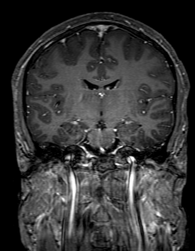 Cerebral arteriovenous malformation at posterior body of corpus callosum (Radiopaedia 74111-84925 K 184).jpg