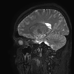 Cerebral arteriovenous malformation at posterior body of corpus callosum (Radiopaedia 74111-84925 Sagittal T2 45).jpg