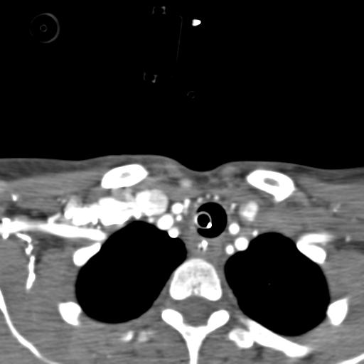 Cerebral arteriovenous malformation with hemorrhage (Radiopaedia 28773-29073 A 97).jpg