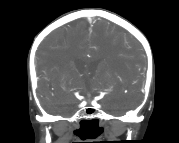 Cerebral arteriovenous malformation with lobar hemorrhage (Radiopaedia 44725-48511 A 27).png