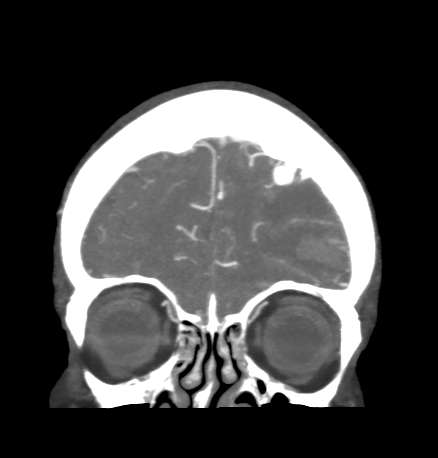 Cerebral arteriovenous malformation with lobar hemorrhage (Radiopaedia 44725-48511 B 11).png