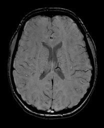 File:Cerebral cavernous venous malformation (Radiopaedia 70008-80021 I 44).jpg