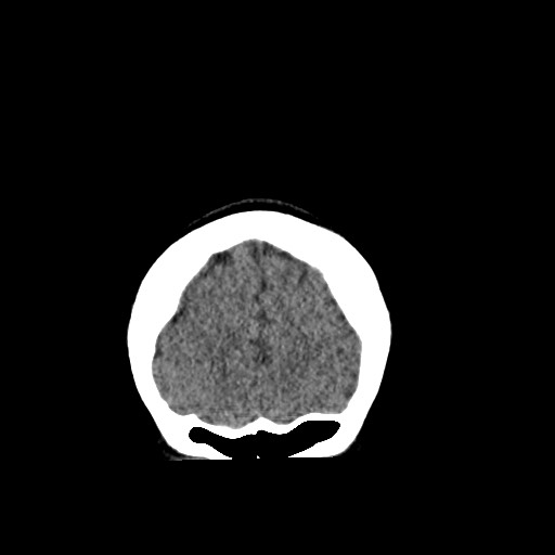 File:Cerebral cavernous venous malformation (Radiopaedia 70008-80022 non-contrast 8).jpg