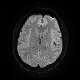 Cerebral cavernous venous malformation (Zabramski type II) (Radiopaedia 85511-101198 Axial DWI 19).jpg