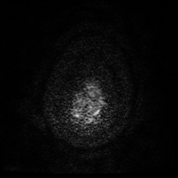 Cerebral cavernous venous malformation (Zabramski type II) (Radiopaedia 85511-101198 Axial DWI 33).jpg