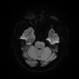 Cerebral cavernous venous malformation (Zabramski type II) (Radiopaedia 85511-101198 Axial DWI 44).jpg