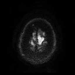 Cerebral cavernous venous malformation (Zabramski type II) (Radiopaedia 85511-101198 Axial DWI 62).jpg