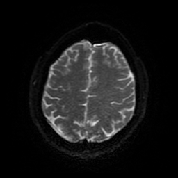 Cerebral cavernous venous malformation (Zabramski type II) (Radiopaedia 85511-101198 Axial DWI 90).jpg