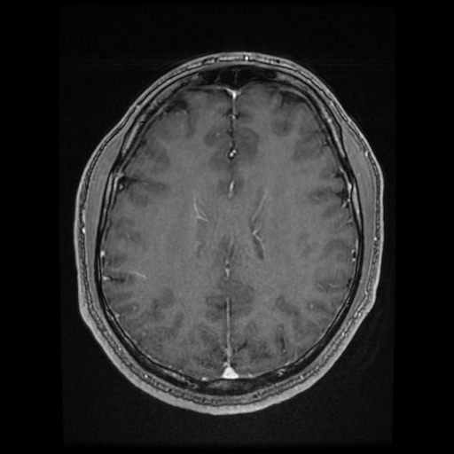 Cerebral cavernous venous malformation (Zabramski type II) (Radiopaedia 85511-101198 Axial T1 C+ fat sat 34).jpg