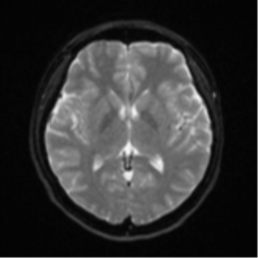 Cerebral cavernous venous malformations (Radiopaedia 48117-52946 Axial DWI 14).png