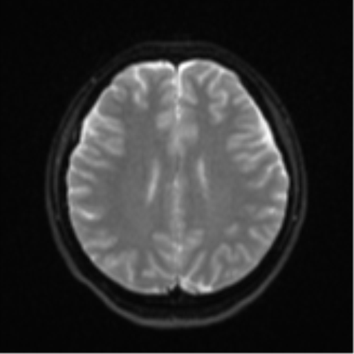 Cerebral cavernous venous malformations (Radiopaedia 48117-52946 Axial DWI 18).png