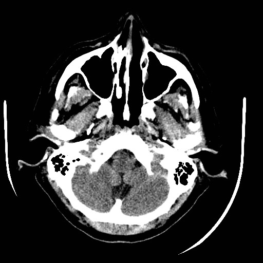 File:Cerebral edema (evolution in time) (Radiopaedia 19418-19440 non-contrast 16).jpg