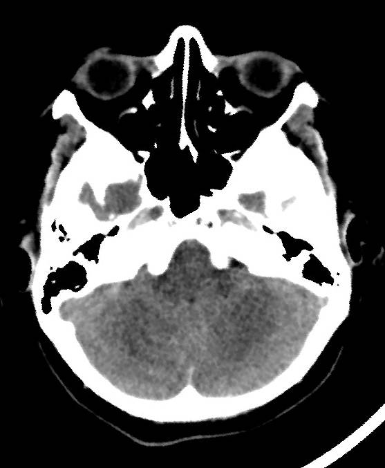 Cerebral edema due to severe hyponatremia (Radiopaedia 89826-106937 Axial non-contrast 19).jpg