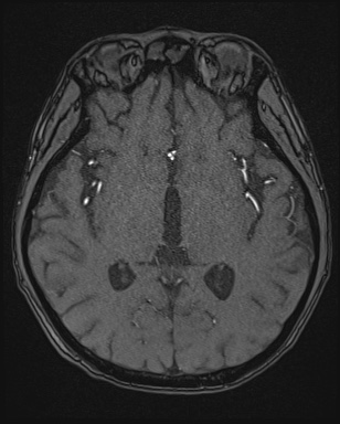 Cerebral embolic infarcts (embolic shower) (Radiopaedia 72391-82921 Axial MRA 86).jpg