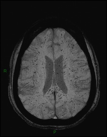 Cerebral fat embolism (Radiopaedia 35022-36525 Axial SWI 31).jpg