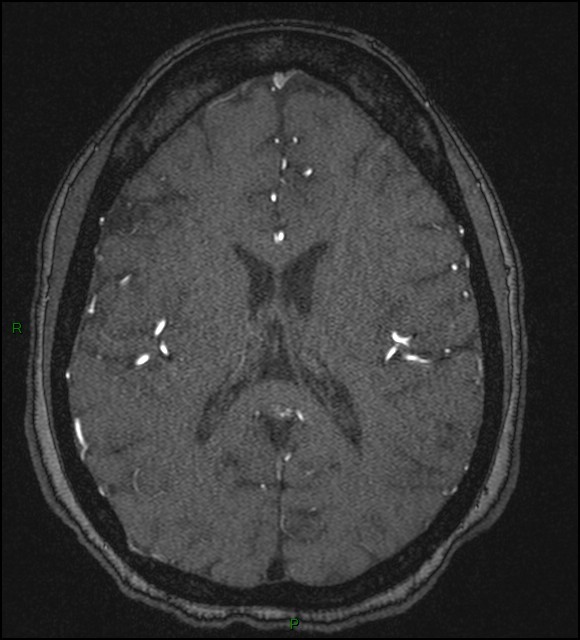 Cerebral fat embolism (Radiopaedia 35022-36525 Axial TOF 125).jpg