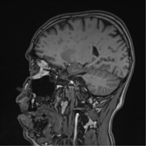 Cerebral fat embolism (Radiopaedia 57697-64639 Sagittal T1 22).png