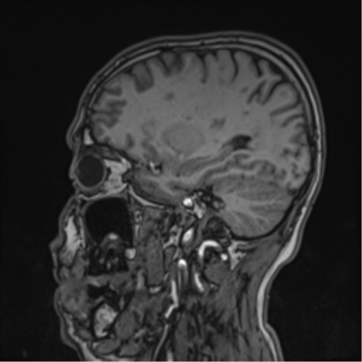 Cerebral fat embolism (Radiopaedia 57697-64639 Sagittal T1 34).png