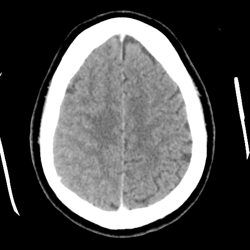 File:Cerebral hemorrhage secondary to arteriovenous malformation (Radiopaedia 33497-34561 B 42).png