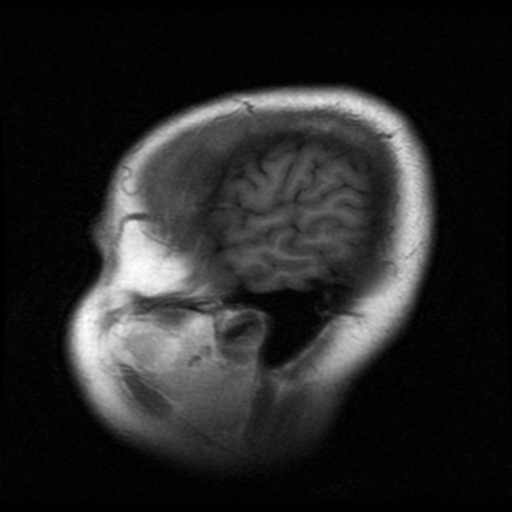 File:Cerebral hemorrhage secondary to arteriovenous malformation (Radiopaedia 33497-34572 Sagittal T1 2).png
