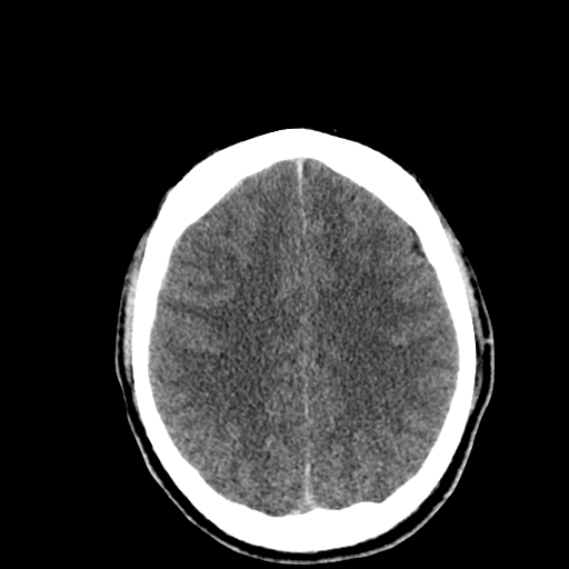 File:Cerebral hemorrhagic contusions- temporal evolution (Radiopaedia 40224-42753 Axial non-contrast 24).png