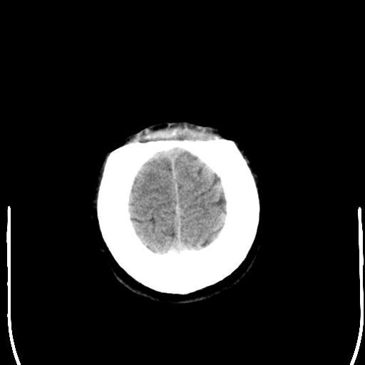 File:Cerebral hemorrhagic contusions- temporal evolution (Radiopaedia 40224-42756 Axial non-contrast 26).png