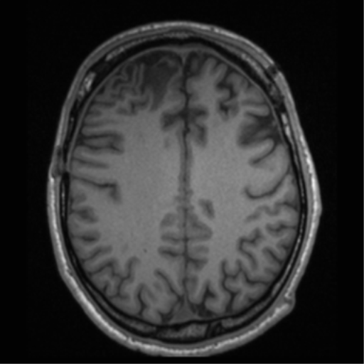 Cerebral hemorrhagic contusions- temporal evolution (Radiopaedia 40224-42757 Axial T1 54).png