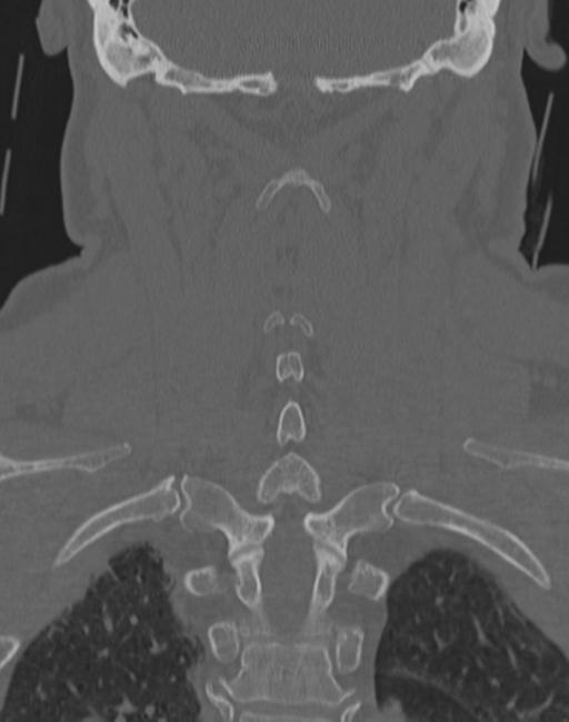 Cerebral hemorrhagic contusions and cervical spine fractures (Radiopaedia 32865-33841 Coronal bone window 53).jpg