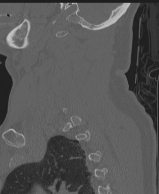 Cerebral hemorrhagic contusions and cervical spine fractures (Radiopaedia 32865-33841 Sagittal bone window 76).jpg