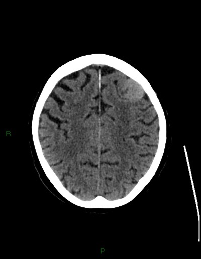 File:Cerebral metastases - ependymal and parenchymal (Radiopaedia 79877-93131 Axial non-contrast 57).jpg