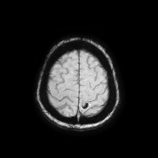 Cerebral metastases - melanoma (Radiopaedia 80972-94522 Axial SWI 85).jpg