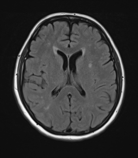 File:Cerebral metastases mimicking abscesses (Radiopaedia 45841-50131 Axial FLAIR 17).png
