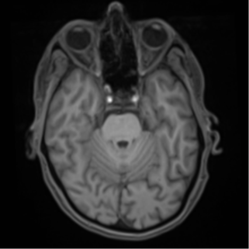 File:Cerebral metastasis - melanoma (Radiopaedia 54718-60954 Axial T1 18).png