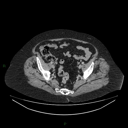 Cerebral metastasis from renal cell carcinoma (Radiopaedia 82306-96378 A 156).jpg