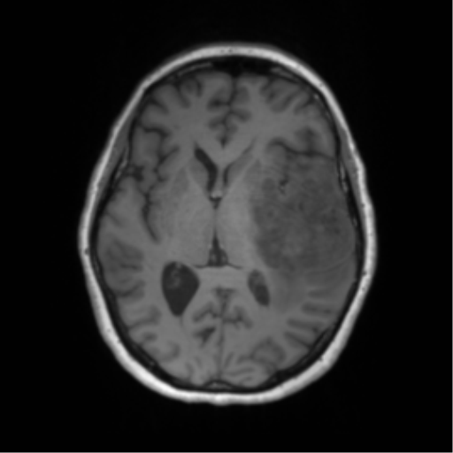 Cerebral metastasis mimicking glioblastoma (Radiopaedia 69155-78937 Axial T1 32).png