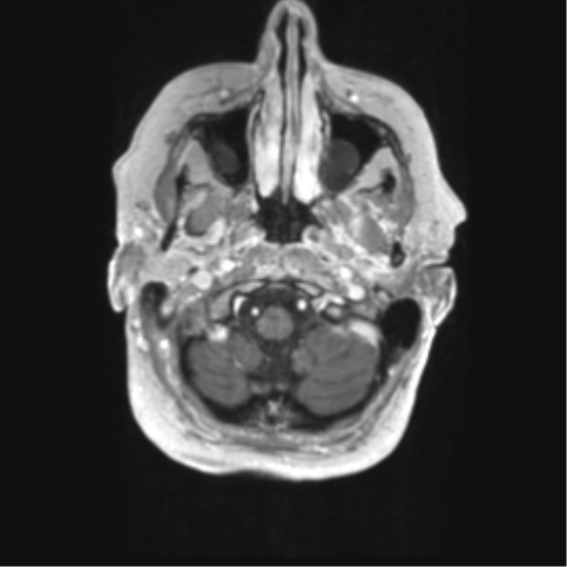 Cerebral metastasis mimicking glioblastoma (Radiopaedia 69155-78937 Axial T1 C+ 2).png