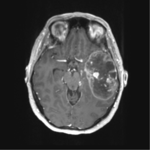 Cerebral metastasis mimicking glioblastoma (Radiopaedia 69155-78937 Axial T1 C+ 24).png