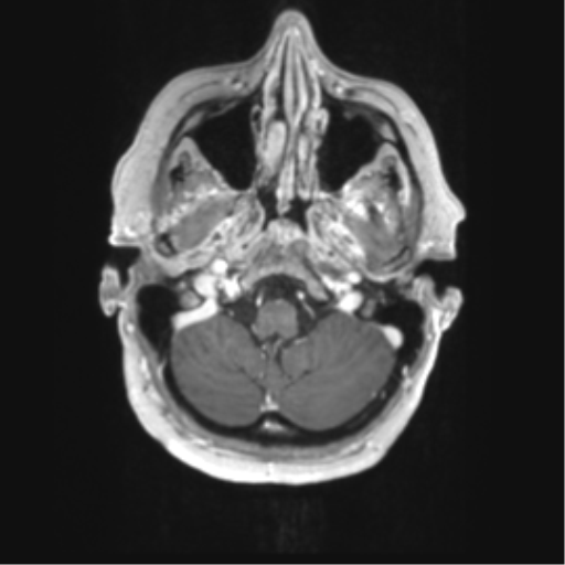 Cerebral metastasis mimicking glioblastoma (Radiopaedia 69155-78937 Axial T1 C+ 6).png