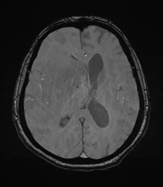 Cerebral metastasis to basal ganglia (Radiopaedia 81568-95413 Axial SWI magnitude 50).png