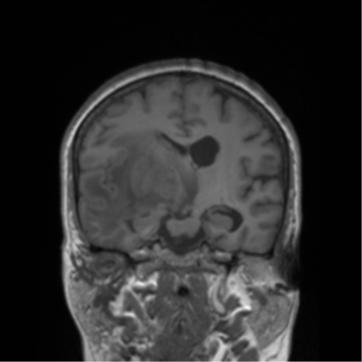 Cerebral metastasis to basal ganglia (Radiopaedia 81568-95413 Coronal T1 27).png