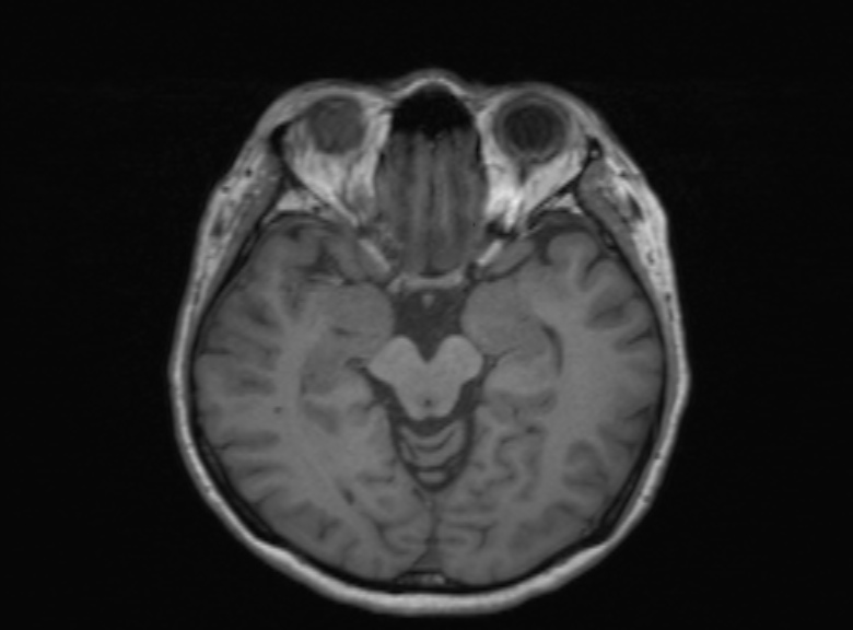Cerebral ring enhancing lesions - cerebral metastases (Radiopaedia 44922-48817 Axial T1 257).jpg