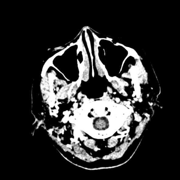 Cerebral ring enhancing lesions - cerebral metastases (Radiopaedia 44922-48818 B 10).jpg