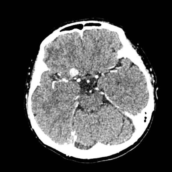 Cerebral ring enhancing lesions - cerebral metastases (Radiopaedia 44922-48818 B 107).jpg